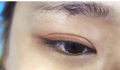 目光呆滞下垂眼