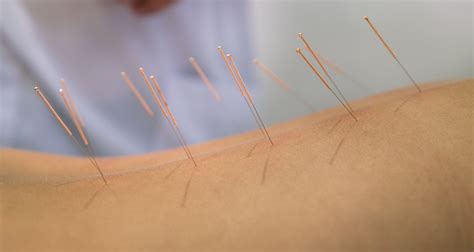 炎黄中医针灸特色针法课程