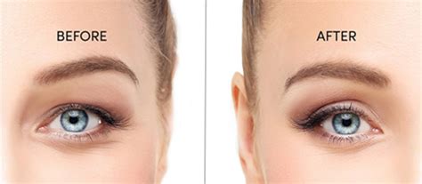 西安埋线双眼皮培训学校