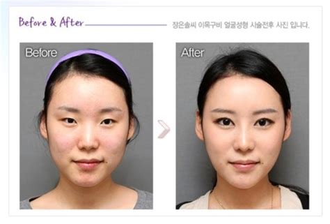 西安双眼皮专业培训班