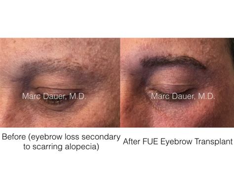 贵阳FUE无痕植眉化妆入门辅导班