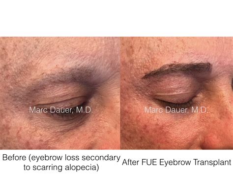 贵阳FUE无痕化妆植眉入门辅导班