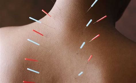 哈尔滨针灸入门培训