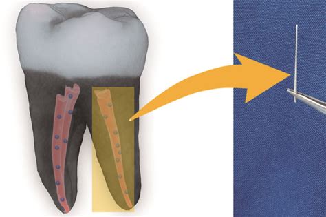 纳米钻石牙齿浮雕技术